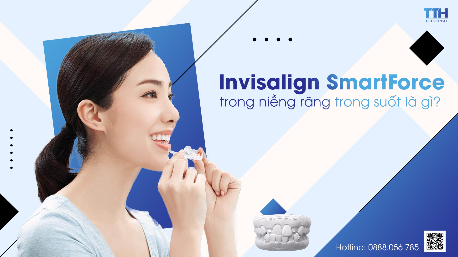 Niềng răng trong suốt tại Nghệ An - Invisalign SmartForce là gì?
